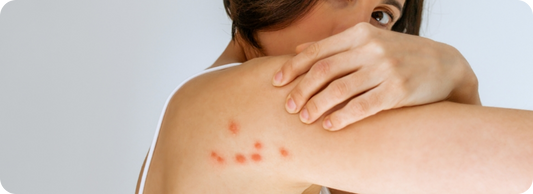 How To Treat Bed Bug Bites